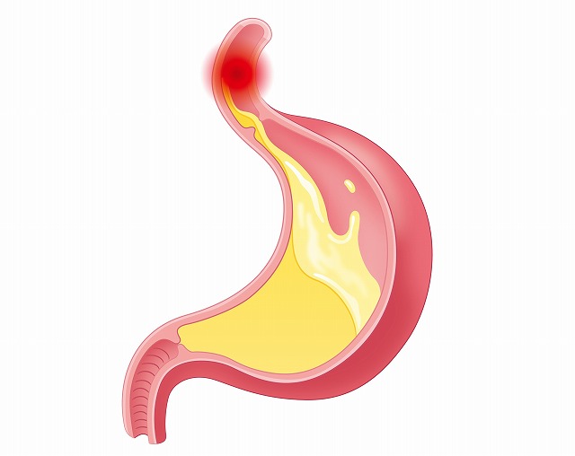 逆流性食道炎とは