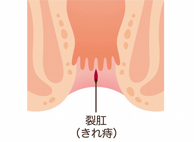 裂肛とは