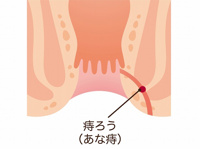 痔瘻とは