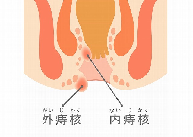 痔核とは