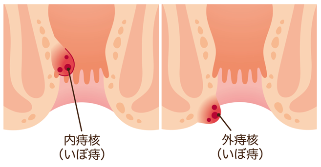 内痔核、外痔核（いぼ痔）